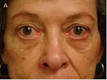 Lanka Cosmetic Dr. Nimal Gamage Rejuvenation Around Eyes - Perior4