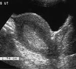 Imaging the <b>Endometrium</b>: Disease and Normal Variants1