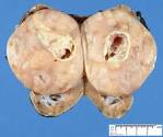 <b>Wilms tumor</b>