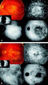 ScienceDirect.com - Ophthalmology - Giulio Porrini, Alfonso Giovannini, Giampaolo Amato, Alfonso Ioni, Marco Pantanetti - 1-s2.0-S0161642002019681-gr1
