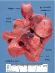 pericardial teratoma - Humpath.com - Human pathology
