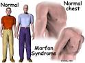 Marfan syndrome is an