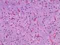 <b>Liposarcoma mixoide</b>