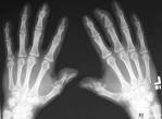 <b>arthritis</b>, <b>Psoriasis</b>