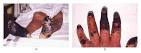 <b>Bacteremia</b> Images