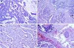 (A) <b>Mucinous adenocarcinoma</b> of