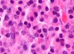 File:<b>Plasmacytoma</b> ultramini1.
