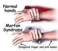 marfan syndrome picture