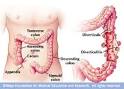 Cure your DIVERTICULITIS today...stop the symptoms and the pain!