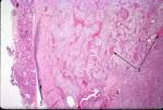 <b>Pleomorphic adenomas</b> are