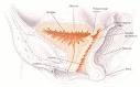 Vesicovaginal <b>fistula</b>