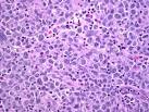 Anaplastic <b>large cell lymphoma</b>