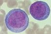 <b>Acute Monocytic Leukemia</b>