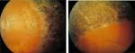What is <b>Refsum disease</b>?