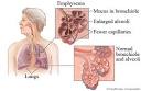 <b>Emphysema</b>