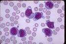 <b>Acute Monocytic Leukemia</b> (M-5)