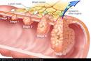 Staging <b>Colorectal Cancer</b>
