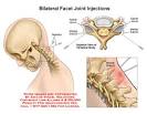 AMICUS Illustration of facet,