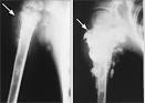 <b>Osteosarcoma</b> arising from the
