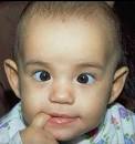 Congenital <b>Esotropia</b> Before