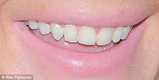 Teeth of Lindsay Lohan