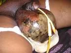 <b>Fournier's Gangrene</b> | InTechOpen
