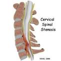 Cervical SPINAL STENOSIS - Orthogate