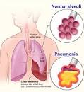 PNEUMONIA - Risk Factors, Symptoms, Diagnosis and Treatment