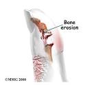 <b>Psoriatic arthritis</b> is a