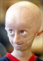 Pronuncia di progeria