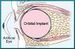 <b>Orbital Implant</b> with