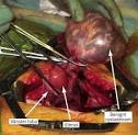 PAD visade <b>seröst cystadenom</b>./