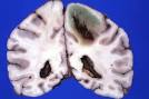 <b>Placenta Diseases</b> - Meducation