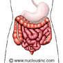 What is diverticulitis?