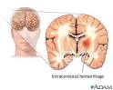 Intracerebral <b>hemorrhage</b>