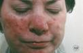 Left untreated, <b>rosacea</b> can