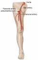 <b>femoral artery</b> aneurysm,