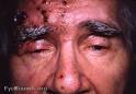 <b>Herpes Zoster Ophthalmicus</b> -