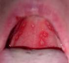 Recurrent aphthous <b>stomatitis</b>