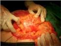 <b>Neoplasias ováricas</b>