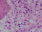 <b>plasmacytoma</b> presenting as