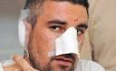 Zoran Nikolić (34) iz Niša ostao je bez dela nosa kada ga je nedaleko od ... - psi napadaju ljude