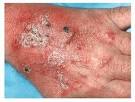 <b>Dermatopatías Vesiculoampollosas</b>; Enfermedades Ampollosas de la