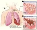 Lobar pneumonia - Wikipedia, the free encyclopedia