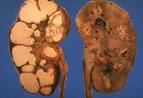 <b>Renal Tuberculosis</b>