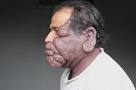 Mohammad Hussain Haemangioma: A benign tumour with abnormal vessels was ... - Mohammad+Hussain