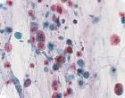 -<b>Lung Cancer</b>: <b>non</b>-<b>small cell</b>-