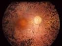 <b>Retinitis Pigmentosa</b> - EyeWiki
