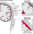 In <b>hemorrhagic</b> strokes