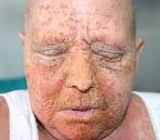 <b>superinfection</b> of eczema